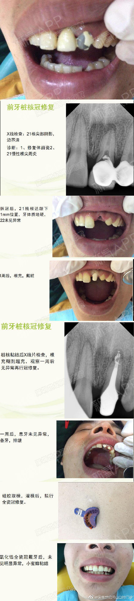 桩核贵金属(贵金属桩核是什么材料)