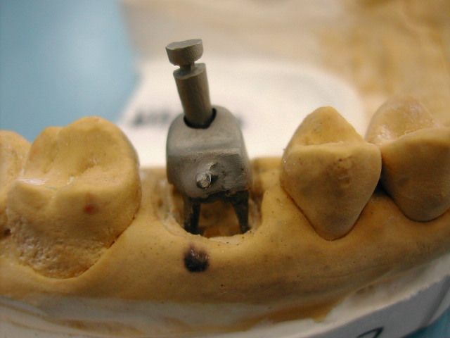 桩核贵金属(贵金属桩核是什么材料)