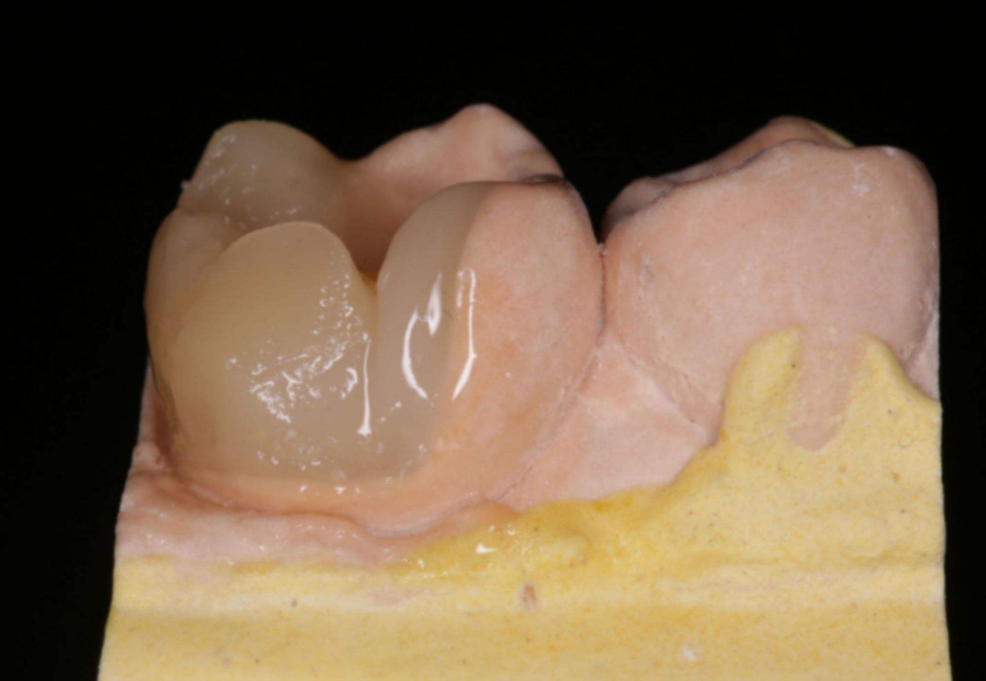 贵金属嵌体(贵金属嵌体图片) 贵金属嵌体(贵金属嵌体图片)