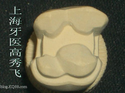 贵金属嵌体(贵金属嵌体图片) 贵金属嵌体(贵金属嵌体图片)