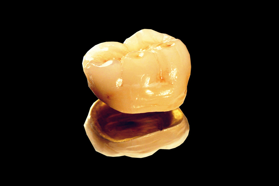 贵金属烤瓷冠(贵金属烤瓷冠价格)