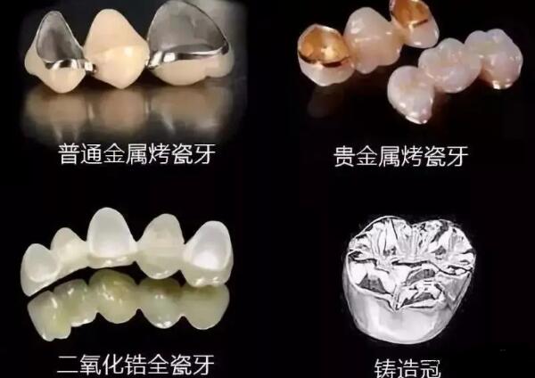 贵金属烤瓷冠(贵金属烤瓷冠和磁共振) 贵金属烤瓷冠(贵金属烤瓷冠和磁共振)