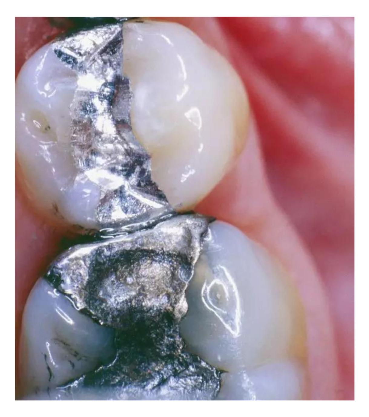 桩核贵金属(金属桩核用什么粘接)