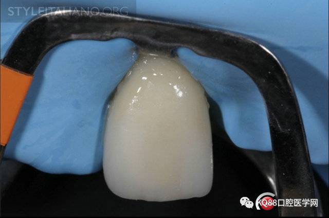 桩核贵金属(贵金属桩核磁共振有影响吗) 桩核贵金属(贵金属桩核磁共振有影响吗)