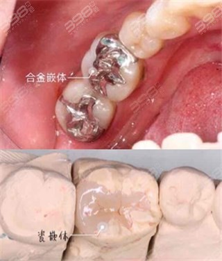 贵金属嵌体(贵金属嵌体粘接用什么粘接剂)