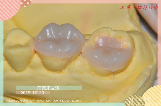 贵金属嵌体(贵金属嵌体粘接用什么粘接剂)