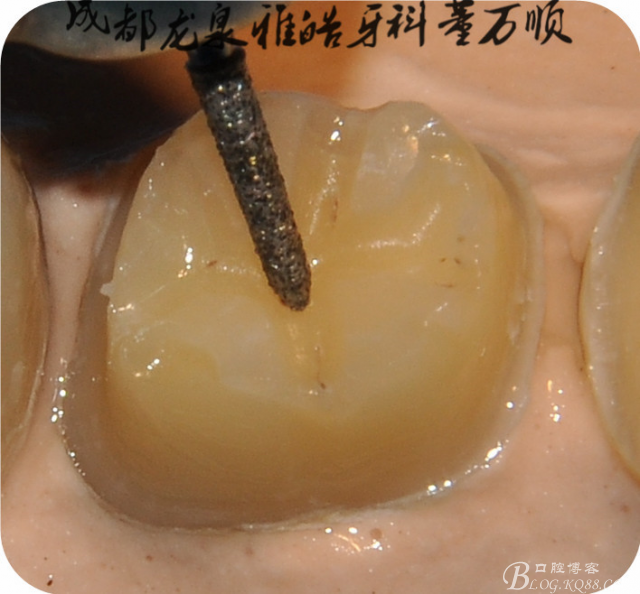 贵金属嵌体(贵金属嵌体是什么金属)