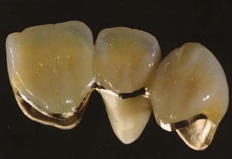 贵金属牙桩(贵金属牙桩银桩做CT和磁共振有影响嘛)