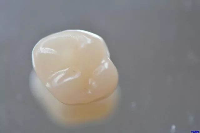 贵金属嵌体(贵金属嵌体与瓷嵌体)