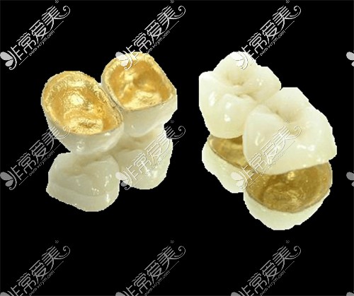 贵金属烤瓷牙的种类(贵金属烤瓷牙是什么材质)