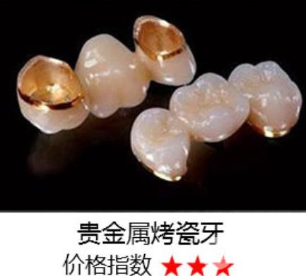 半贵金属烤瓷牙(半贵金属烤瓷牙多少钱)