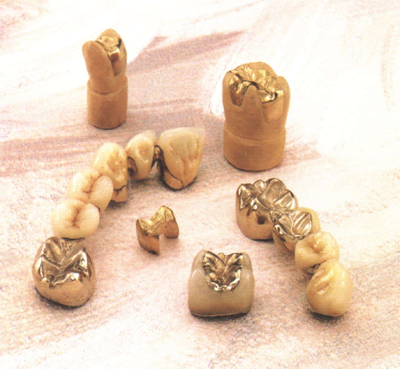 半贵金属烤瓷牙(半贵金属烤瓷牙多少钱)