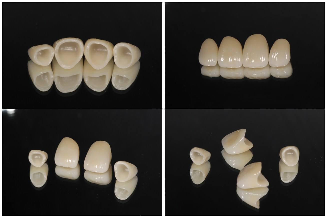 贵金属烤瓷牙的种类(贵金属烤瓷牙的种类及特点)