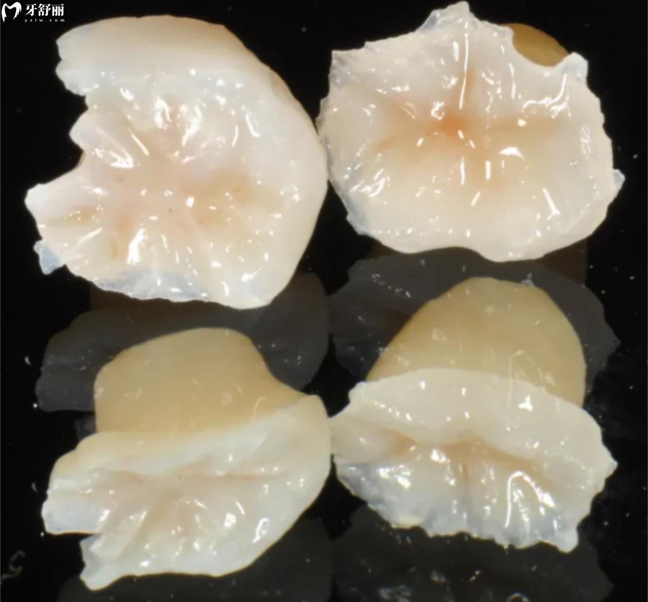 贵金属嵌体(贵金属嵌体黄金含量) 贵金属嵌体(贵金属嵌体黄金含量)