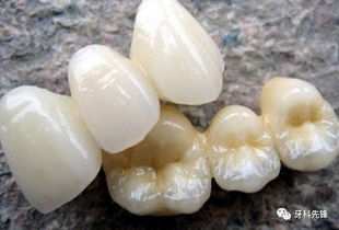 贵金属烤瓷冠(贵金属烤瓷冠与全瓷冠)