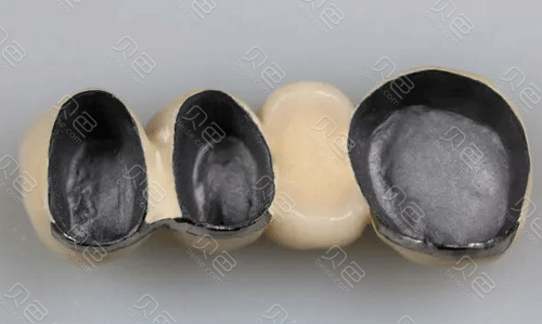 贵金属烤瓷冠(贵金属烤瓷冠与全瓷冠)