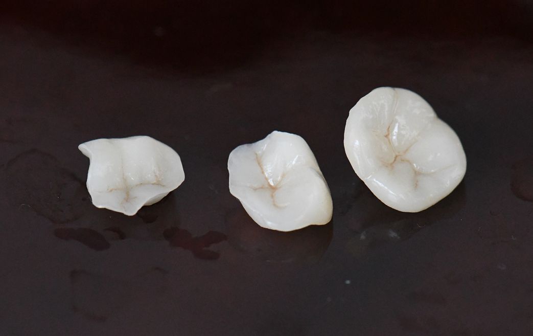 贵金属嵌体(贵金属嵌体可以做核磁吗?)