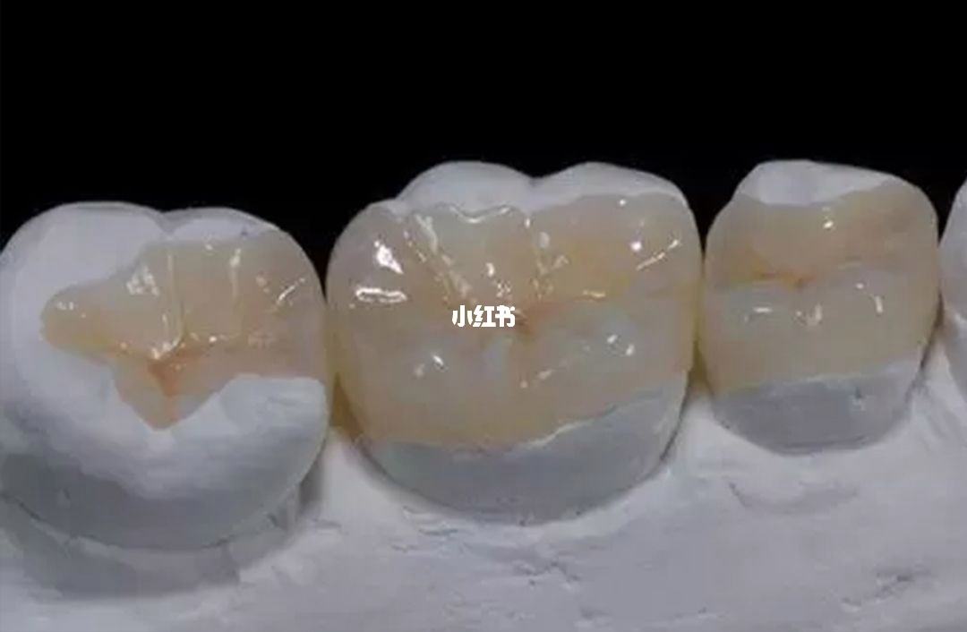 贵金属嵌体(贵金属嵌体可以做核磁吗?)