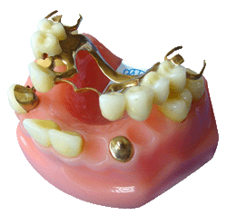 贵金属牙桩(贵金属牙桩影响核磁共振吗) 贵金属牙桩(贵金属牙桩影响核磁共振吗)