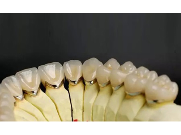 贵金属烤瓷冠(贵金属烤瓷冠的特点)