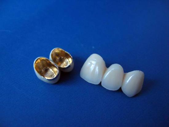 贵金属烤瓷冠(贵金属烤瓷冠的特点) 贵金属烤瓷冠(贵金属烤瓷冠的特点)