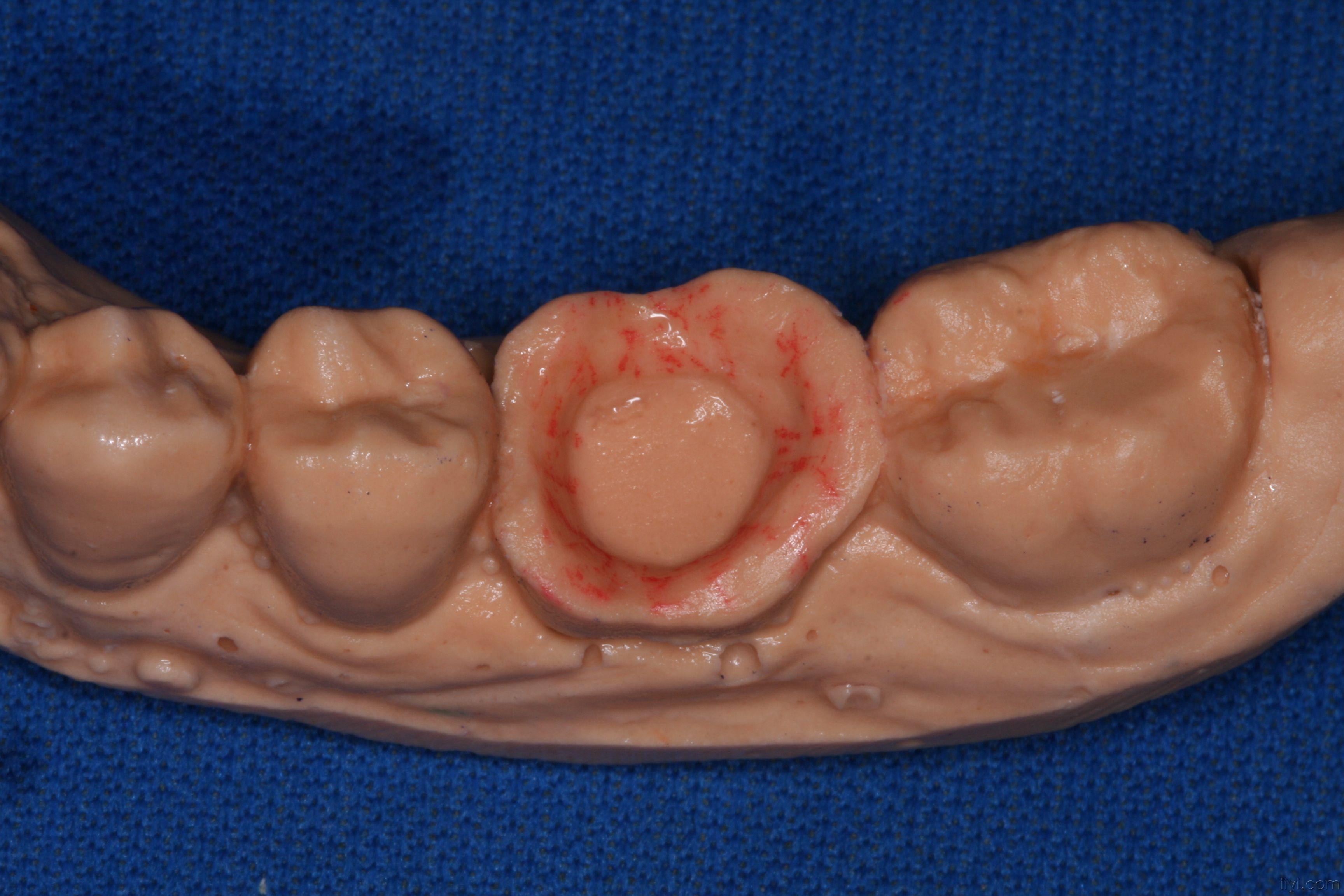 贵金属嵌体(贵金属嵌体和高贵金属区别大吗)