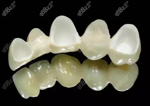 贵金属牙桩(贵金属牙桩是什么材质)