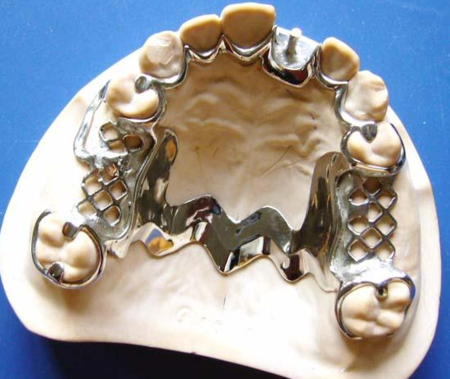 贵金属牙桩(贵金属牙桩多少钱)