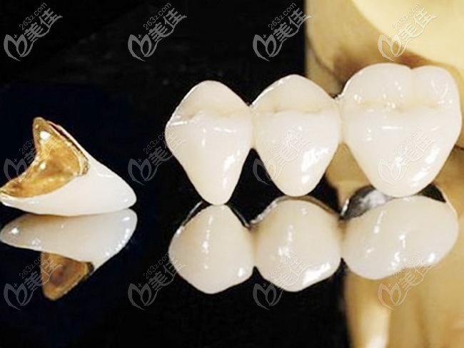 贵金属牙桩(金属牙桩价格) 贵金属牙桩(金属牙桩价格)