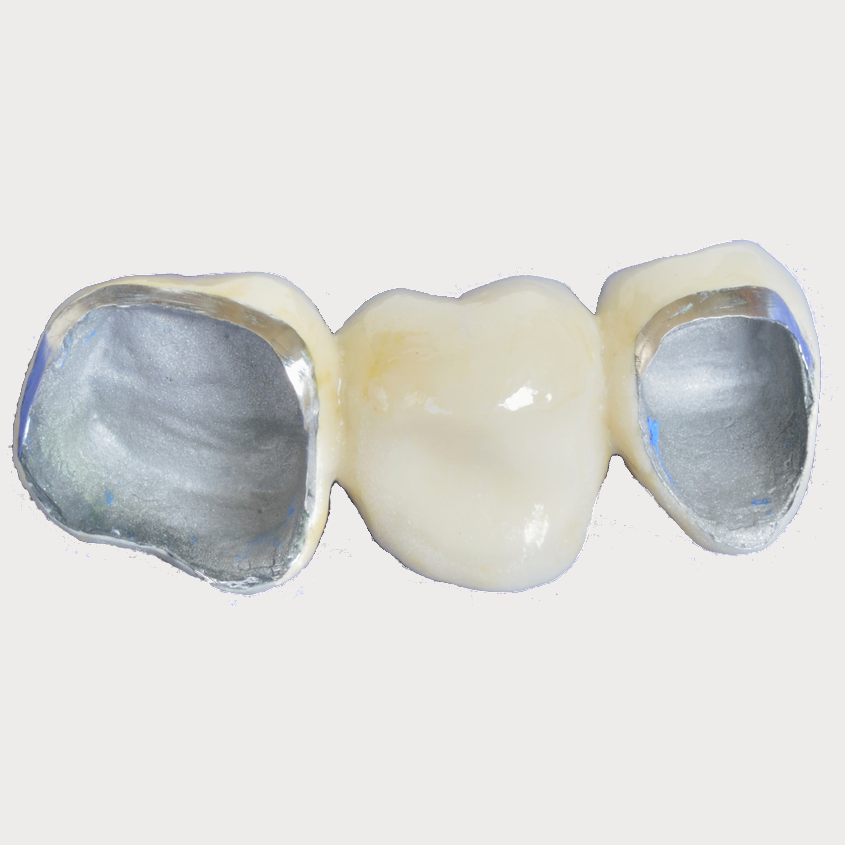 贵金属烤瓷牙的种类(贵金属烤瓷牙的种类有哪些)