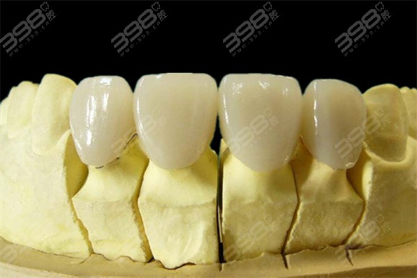 贵金属烤瓷牙的种类(贵金属烤瓷牙的种类有哪些) 贵金属烤瓷牙的种类(贵金属烤瓷牙的种类有哪些)