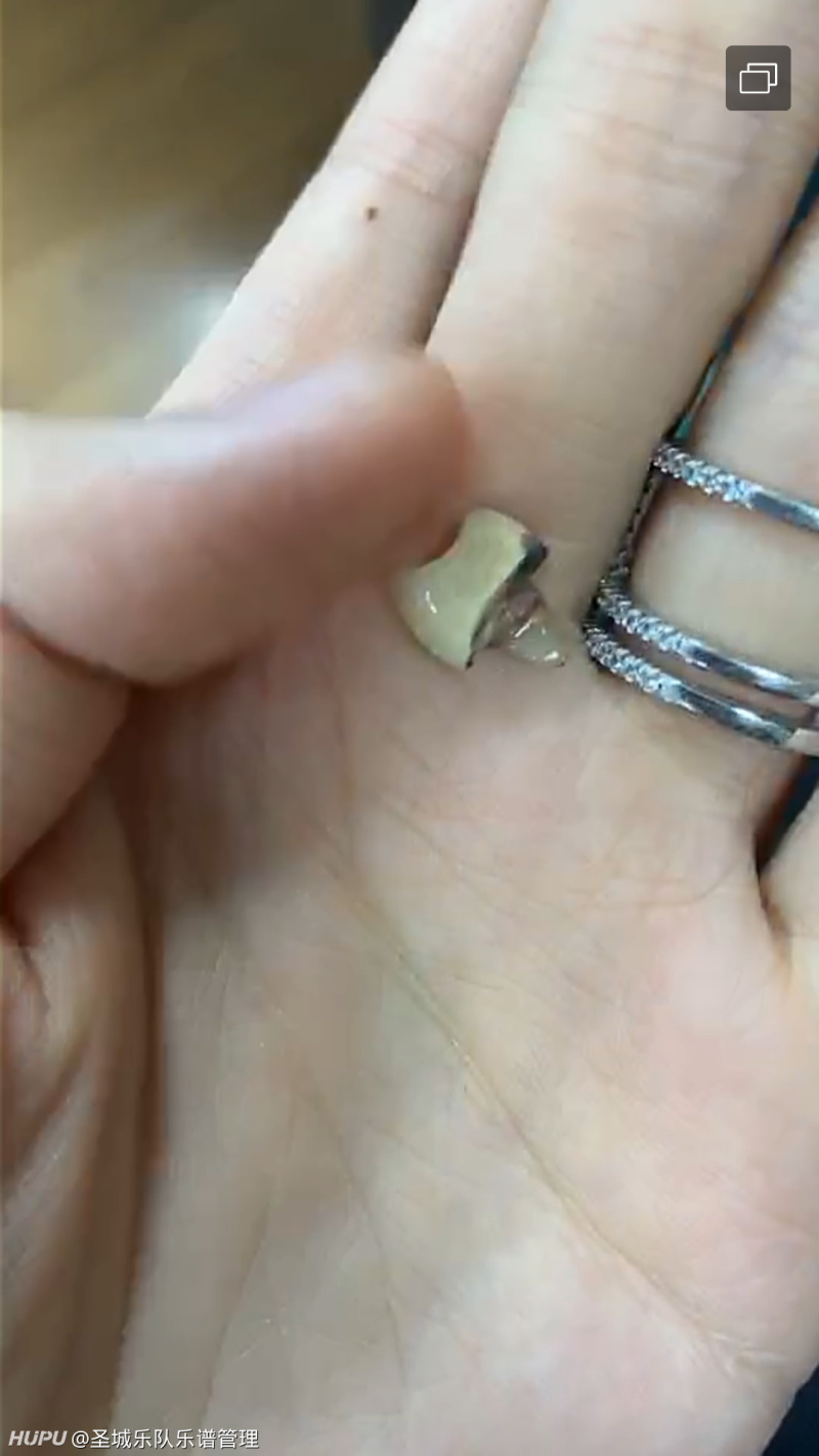 贵金属牙桩(贵金属牙桩能不能拆) 贵金属牙桩(贵金属牙桩能不能拆)