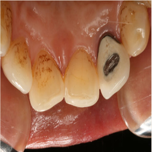 贵金属牙桩(贵金属牙桩能不能拆) 贵金属牙桩(贵金属牙桩能不能拆)