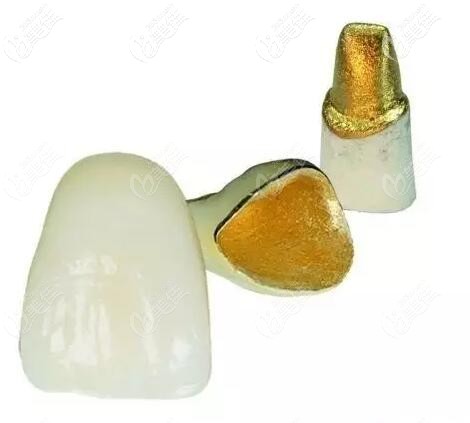 贵金属牙桩(贵金属牙桩做ct有影响嘛)