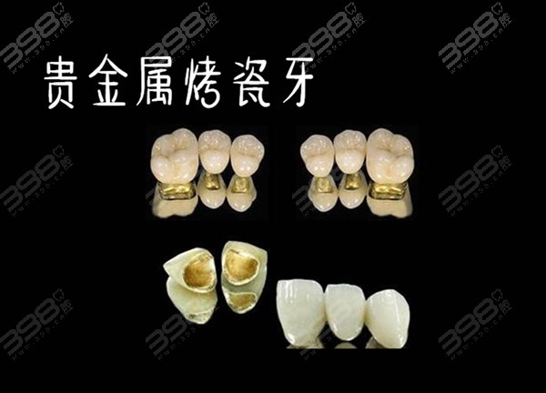 贵金属牙桩(贵金属牙桩做ct有影响嘛) 贵金属牙桩(贵金属牙桩做ct有影响嘛)