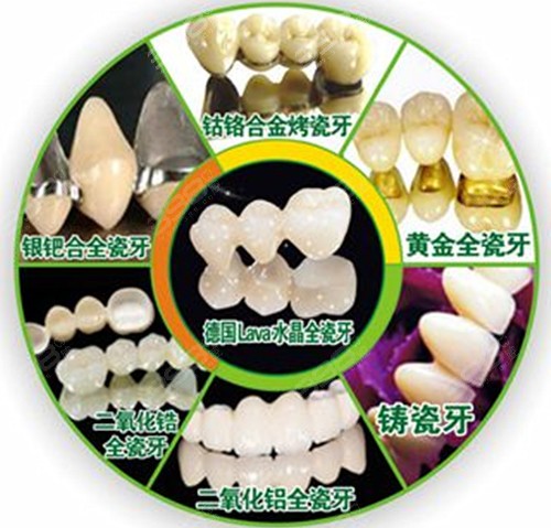 贵金属烤瓷冠(贵金属烤瓷冠的特点中正确的是)