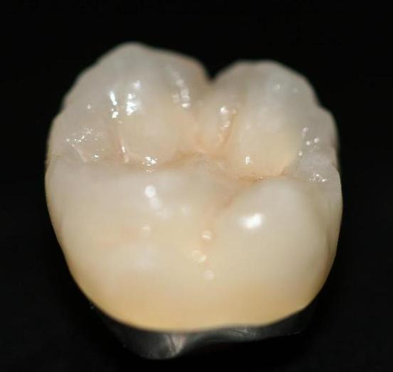 贵金属烤瓷冠(贵金属烤瓷冠的特点中正确的是) 贵金属烤瓷冠(贵金属烤瓷冠的特点中正确的是)