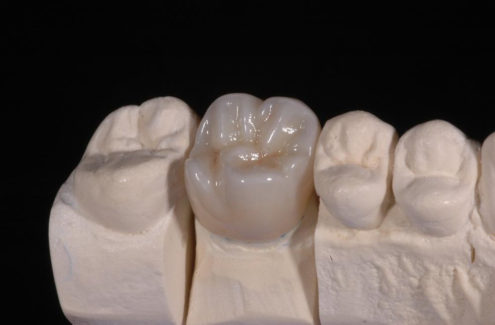 牙科贵金属(为什么牙科贵金属不包括银)