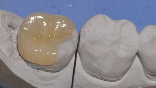 贵金属嵌体(金属嵌体的缺点)