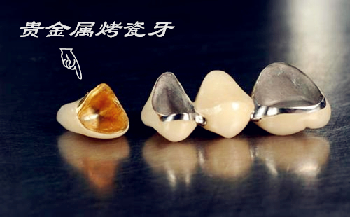 贵金属牙桩(贵金属牙桩为什么是灰色的)