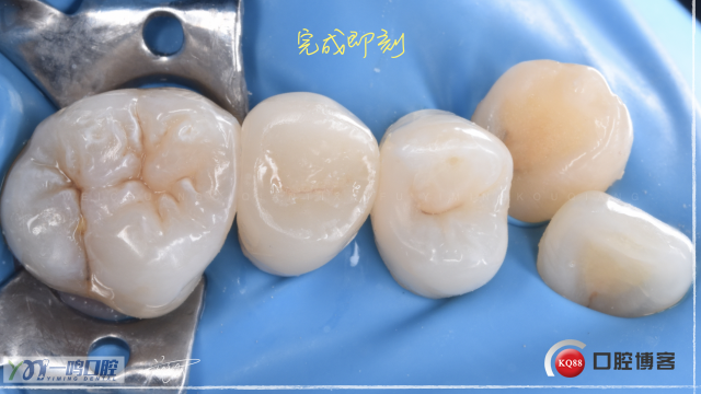 贵金属嵌体(贵金属嵌体的好处)