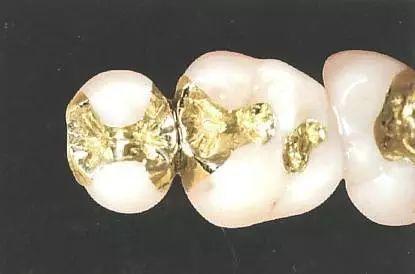贵金属嵌体(贵金属嵌体有哪些种类)