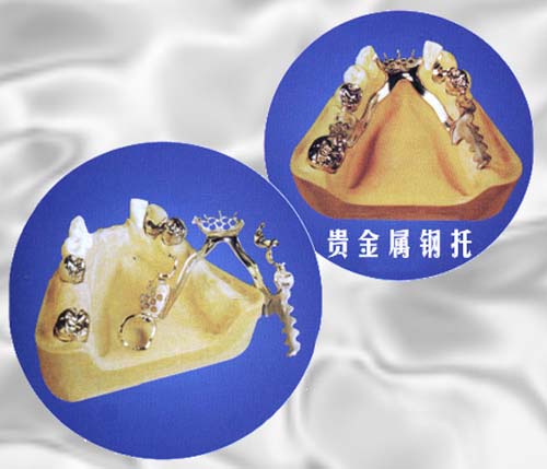 贵金属嵌体(嵌体冠和高嵌体的不同)