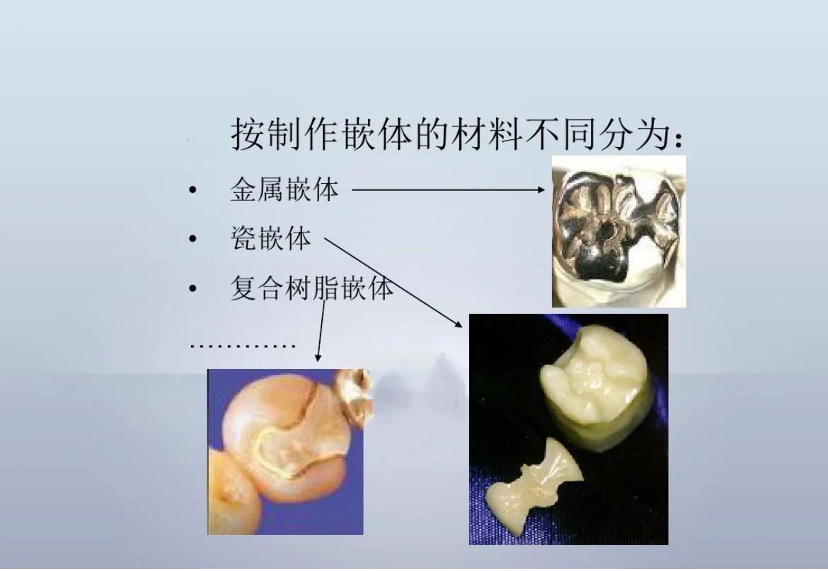 贵金属嵌体(嵌体冠和高嵌体的不同)