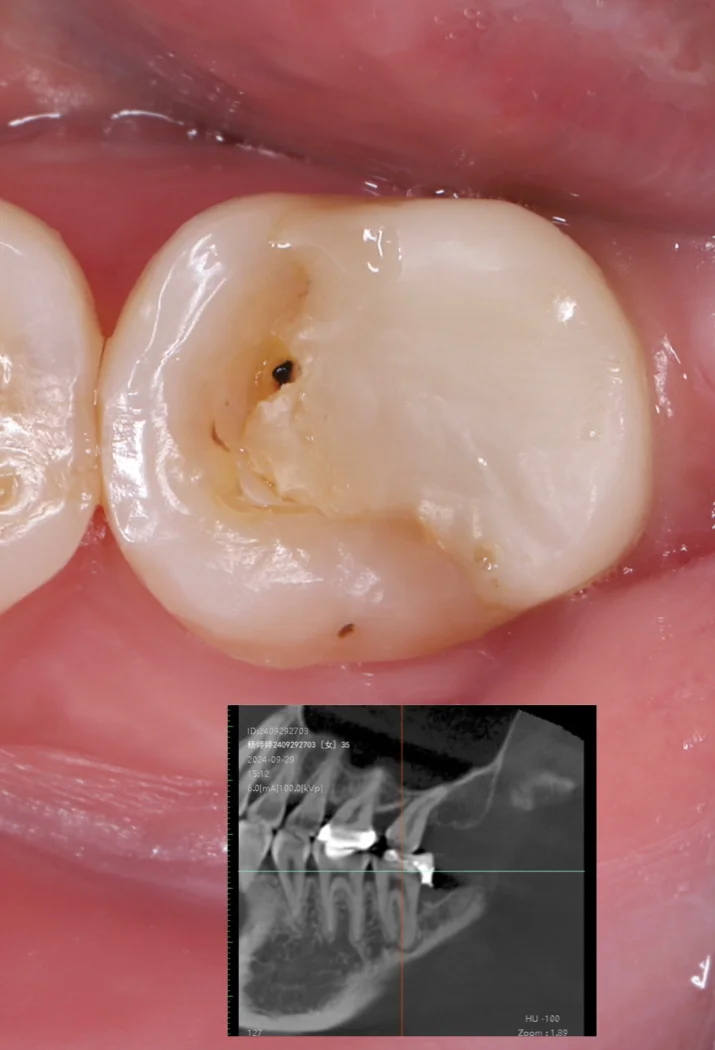贵金属嵌体(金属嵌体大约多少钱一颗)