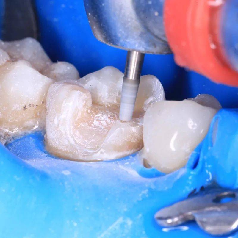 贵金属嵌体(贵金属嵌体术后注意事项)