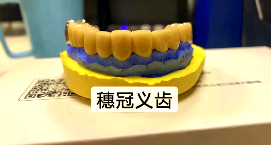 贵金属烤瓷冠(烤瓷牙多少钱一颗价格表2025) 贵金属烤瓷冠(烤瓷牙多少钱一颗价格表2025)
