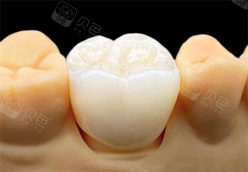 贵金属烤瓷冠(贵金属烤瓷冠适合什么人)