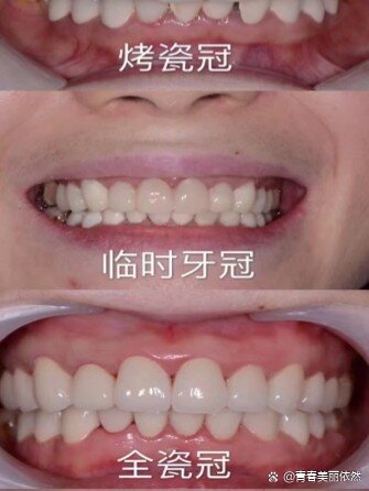 贵金属烤瓷冠(贵金属烤瓷冠修复)