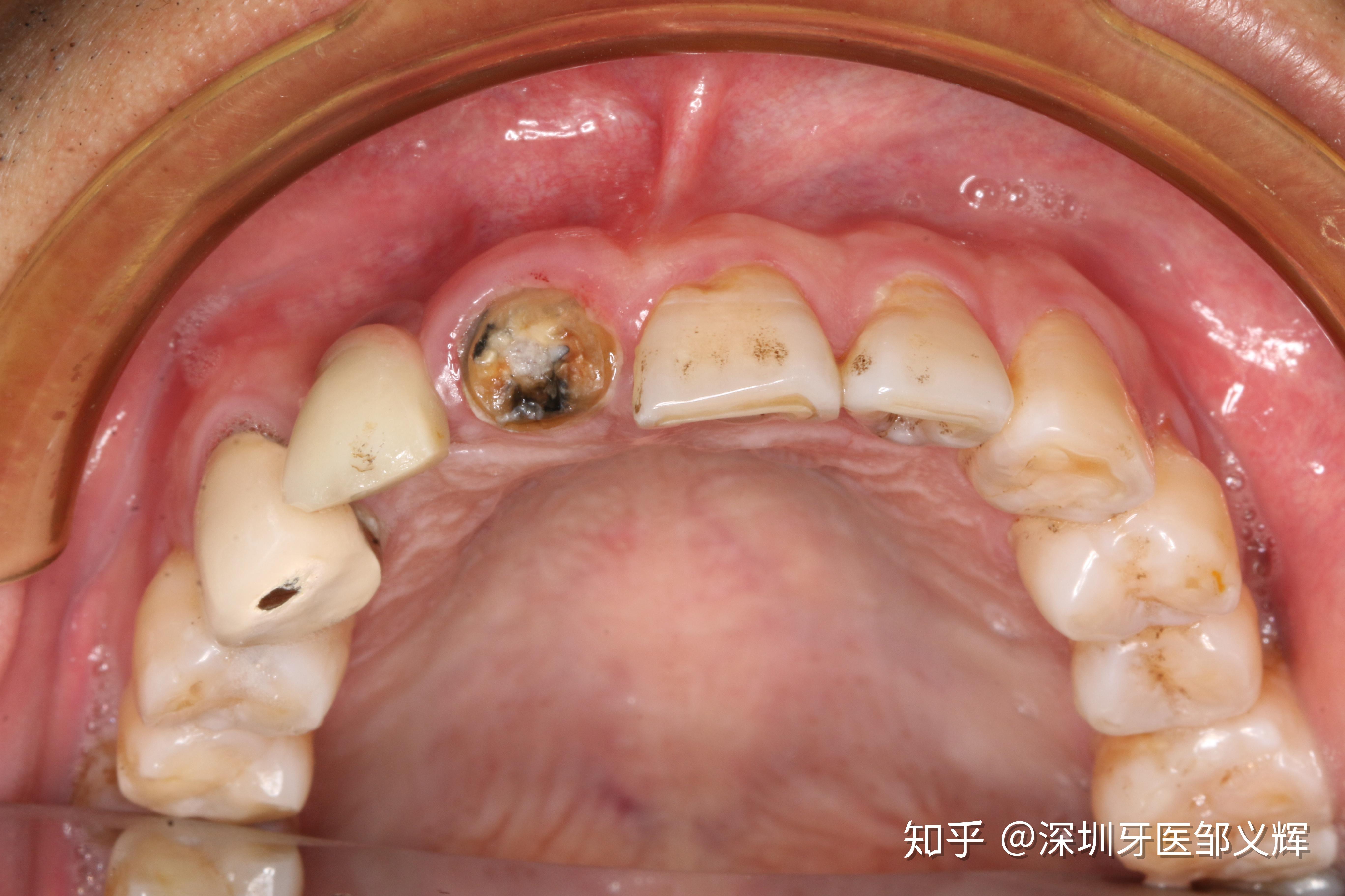 贵金属牙桩(贵金属牙桩最怕三个东西) 贵金属牙桩(贵金属牙桩最怕三个东西)